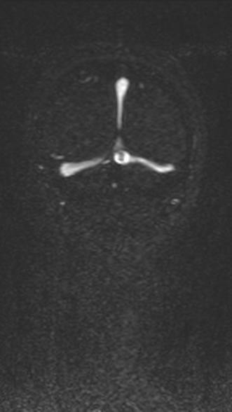 Normal MRI brain with MRV- teenager (Radiopaedia 49425-54553 Coronal MRV 209).jpg