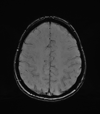 Normal brain MRI (TLE protocol) (Radiopaedia 40748-43405 Axial SWI 65).png