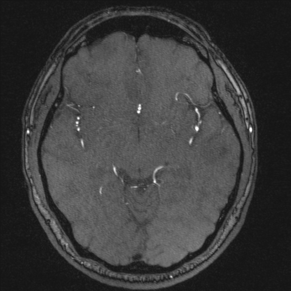 Normal brain MRI including MRA (Radiopaedia 48748-53763 Axial MRA 96).jpg