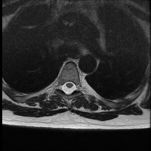 File:Normal cervical and thoracic spine MRI (Radiopaedia 35630-37156 H 31).png
