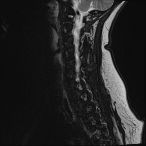 File:Normal cervical spine MRI (including Dixon) (Radiopaedia 42762-45925 Dixon- opposed phase 5).png