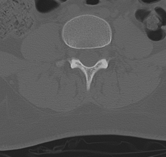 File:Normal lumbosacral CT (Radiopaedia 37923-39867 Axial bone window 64).png