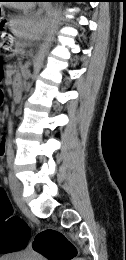 Normal lumbosacral CT (Radiopaedia 37923-39867 E 44).png