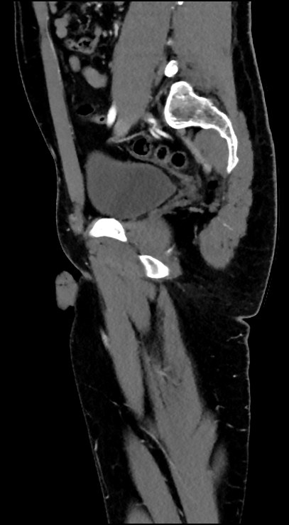 Normal pelvis CT angiogram (Radiopaedia 84966-100481 C 44).jpg
