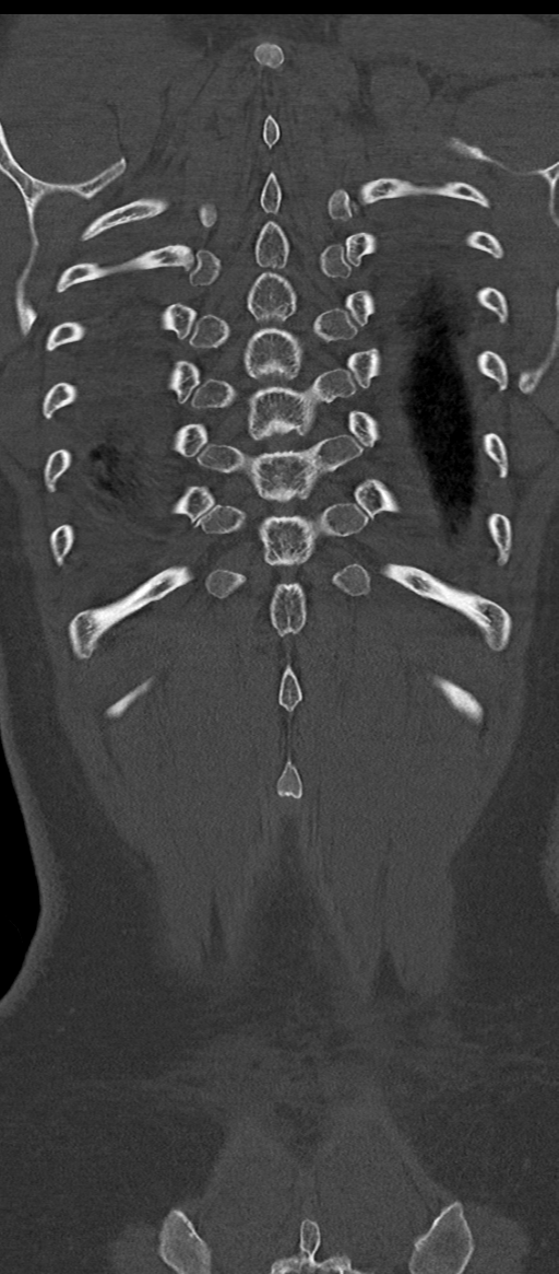 Normal thoracolumbar spine (Radiopaedia 43822-47309 Coronal bone window 79).png