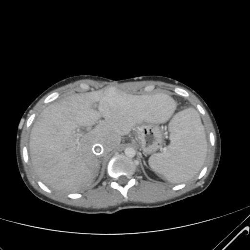 File:Nutmeg liver- Budd-Chiari syndrome (Radiopaedia 46234-50635 B 15).png