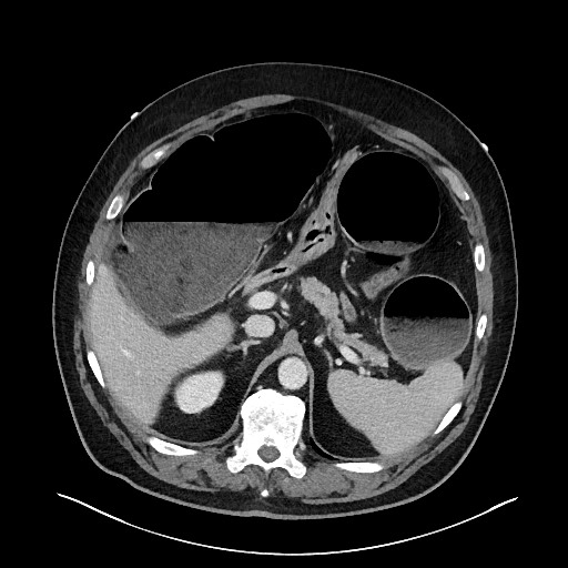 Obstructing sigmoid adenocarcinoma (Radiopaedia 58465-65619 A 47).jpg