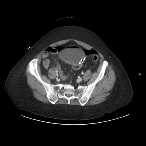Obstructive distal colonic adenocarcinoma causing cecal perforation (Radiopaedia 86830-102989 A 149).jpg