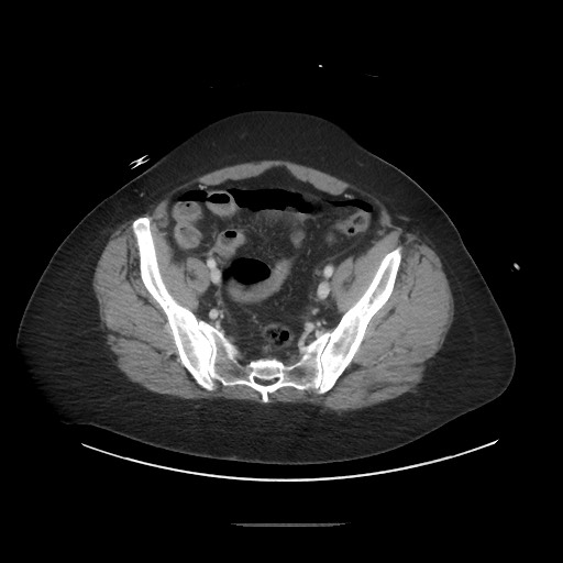 Obstructive distal colonic adenocarcinoma causing cecal perforation (Radiopaedia 86830-102989 A 156).jpg