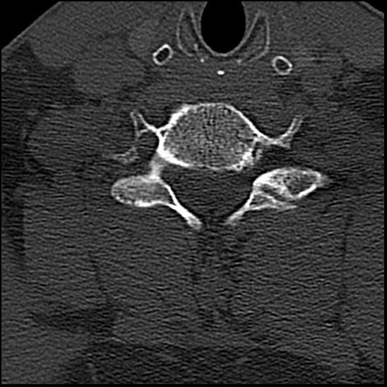 Occipital condyle fracture (type 1) (Radiopaedia 87670-104084 Axial bone window 68).jpg