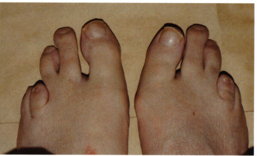 The feet of the elder sibling showed abnormal second and third toes with a shortened fourth metatarsal.