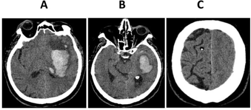 a-c)CT scan images after clinical signs of brain herniation developed