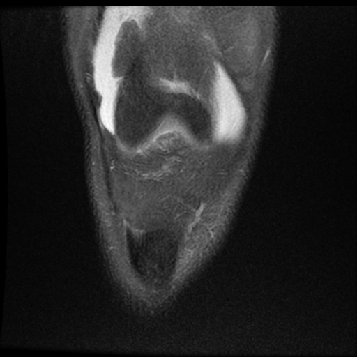 File:ACL acute full thickness tear - deep lateral femoral sulcus sign (Radiopaedia 38594-40740 Coronal PD fat sat 5).jpg