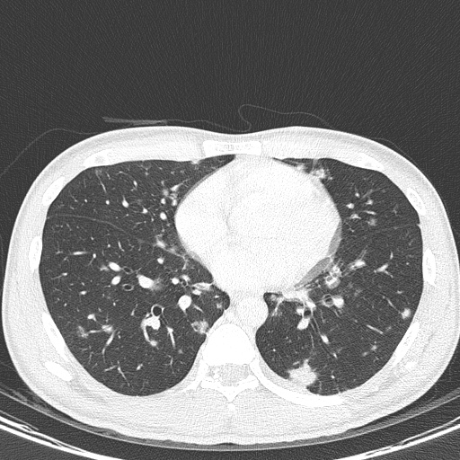 AIDS-related Kaposi sarcoma (Radiopaedia 85247-100811 Axial lung window 106).jpg