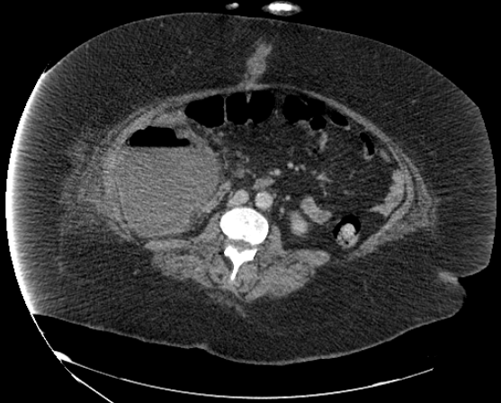 File:Abdominal abscess - pre and post percutaneous drainage (Radiopaedia 60209-67816 Axial 8).png