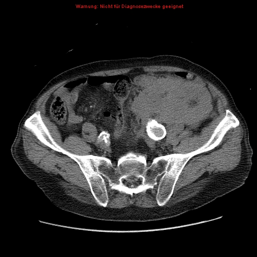 Abdominal aortic aneurysm- extremely large, ruptured (Radiopaedia 19882-19921 Axial C+ arterial phase 58).jpg