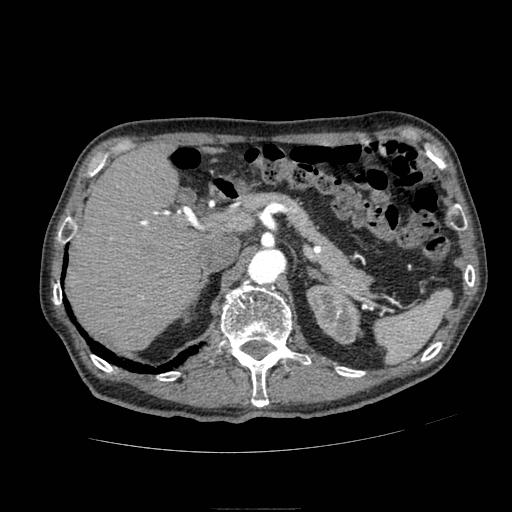 Abdominal aortic aneurysm (Radiopaedia 13341-13340 Axial C+ arterial phase 50).jpg