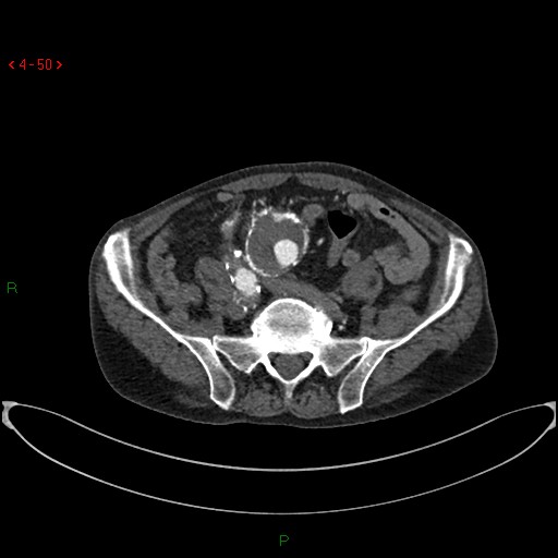 File:Abdominal aortic aneurysm (Radiopaedia 16155-15834 Axial C+ arterial phase 30).jpg