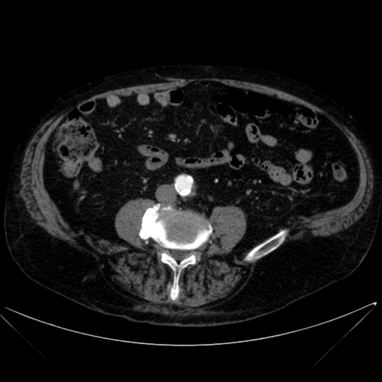 Abdominal aortic aneurysm (Radiopaedia 25855-26001 Axial C+ arterial phase 84).jpg