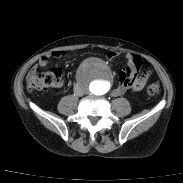 Abdominal aortic aneurysm (Radiopaedia 29248-29660 Axial C+ arterial phase 55).jpg