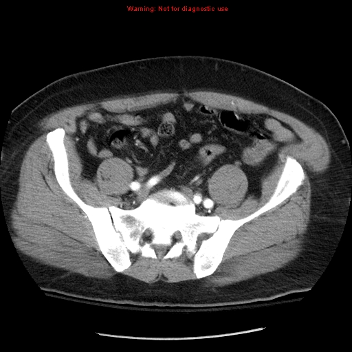 Abdominal aortic aneurysm (Radiopaedia 8190-9038 Axial C+ arterial phase 62).jpg