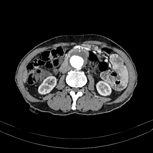 Abdominal aortic aneurysm (Radiopaedia 83581-98689 Axial C+ arterial phase 61).jpg