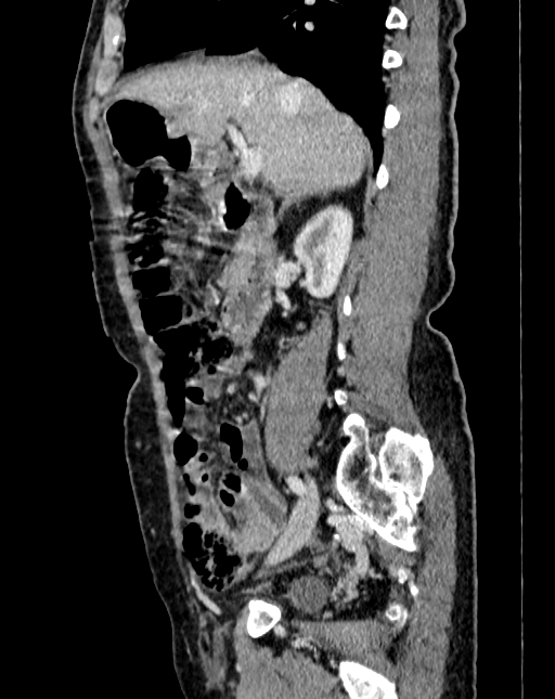 Abdominal aortic aneurysm (Radiopaedia 83581-98689 Sagittal C+ portal venous phase 17).jpg