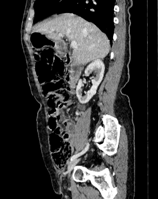 Abdominal aortic aneurysm (Radiopaedia 83581-98689 Sagittal C+ portal venous phase 8).jpg