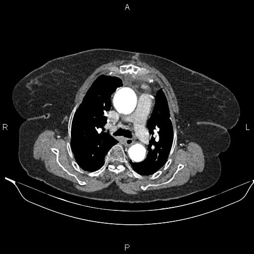 File:Abdominal aortic aneurysm (Radiopaedia 85063-100606 Axial C+ arterial phase 14).jpg
