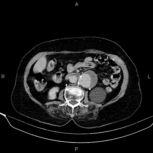 Abdominal aortic aneurysm (Radiopaedia 85063-100606 Axial C+ delayed 53).jpg