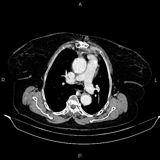 File:Abdominal aortic aneurysm (Radiopaedia 85063-100606 Axial C+ portal venous phase 15).jpg