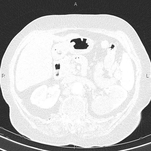 Abdominal aortic aneurysm (Radiopaedia 85063-100606 Axial lung window 69).jpg