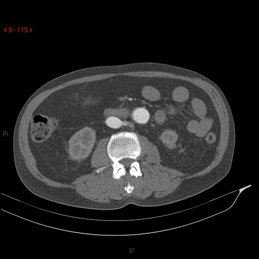 Abdominal aortic aneurysm rupture with aortocaval fistula (Radiopaedia 14897-14841 Axial C+ arterial phase 115).jpg