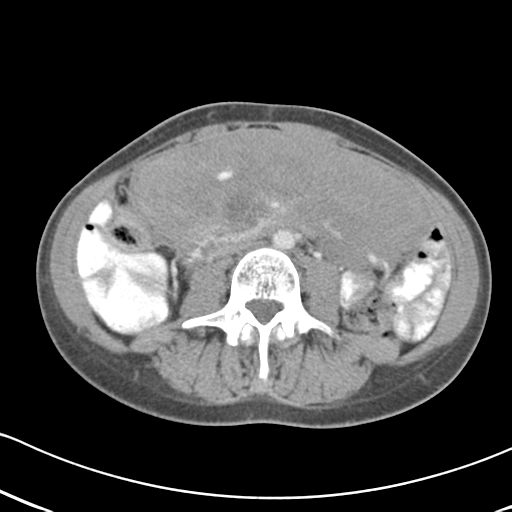 Abdominal desmoid tumor (Radiopaedia 41007-43740 Axial C+ portal venous phase 36).png