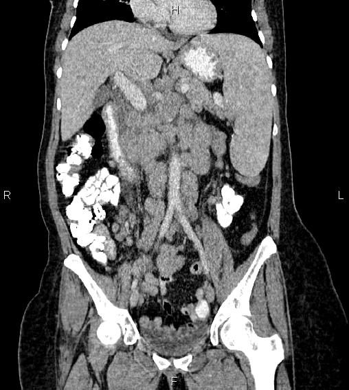 File:Abdominal lymphoma with sandwich sign (Radiopaedia 84378-99704 Coronal C+ portal venous phase 28).jpg