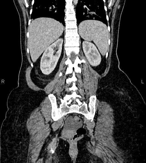 Abdominal lymphoma with sandwich sign (Radiopaedia 84378-99704 Coronal C+ portal venous phase 52).jpg