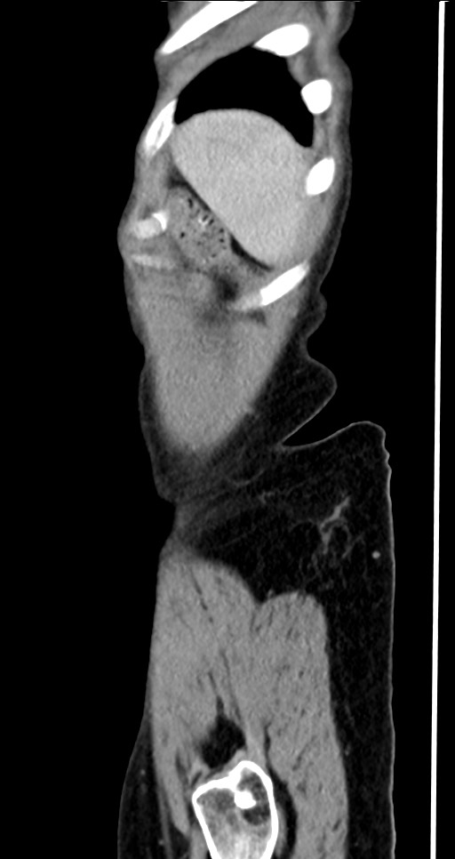 Abdominal wall and retroperitoneal tuberculosis (Radiopaedia 88137-104729 Sagittal C+ portal venous phase 17).jpg