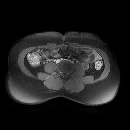 File:Abdominal wall endometriosis (Radiopaedia 83702-98847 Axial T1 C+ fat sat 12).jpg