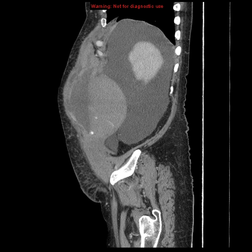 Abdominal wall hematoma (Radiopaedia 9427-10112 Sagittal C+ portal venous phase 90).jpg