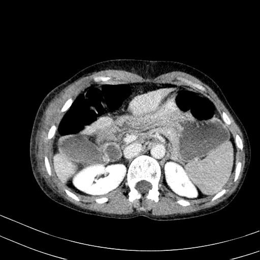 File:Abdominal wall hematoma with active bleeding (Radiopaedia 83915-99117 Axial C+ portal venous phase 6).jpg