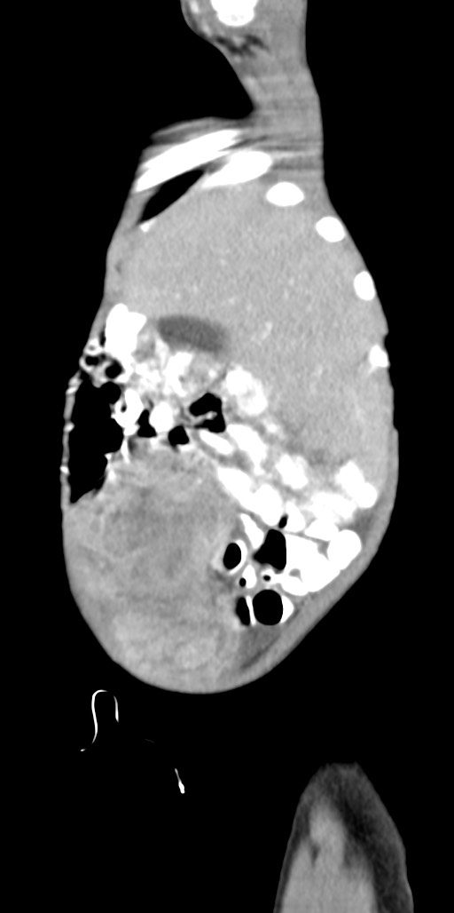 Abdominopelvic rhabdomyosarcoma (Radiopaedia 78356-90984 Sagittal C+ portal venous phase 86).jpg