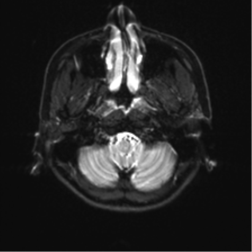 Abducens nerve palsy (Radiopaedia 51069-56648 Axial DWI 2).png