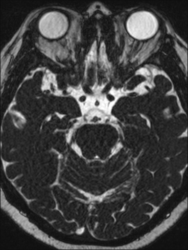 Abducens nerve palsy (Radiopaedia 57084-63976 Axial T2 ciss 3d 48).jpg