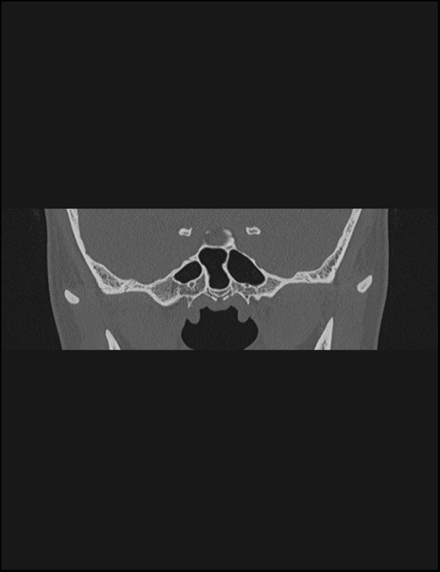 Aberrant right internal carotid artery (Radiopaedia 65191-74198 Coronal non-contrast 2).jpg