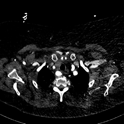 File:Aberrant right subclavian artery with Kommerell diverticulum (Radiopaedia 47982-52769 Axial C+ arterial phase 15).png