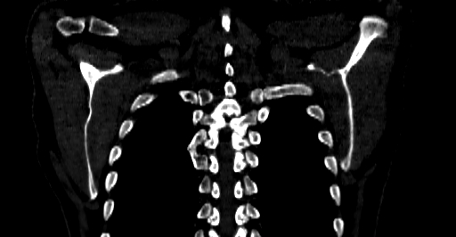 Accesory rib joint (Radiopaedia 71987-82452 Coronal bone window 64).jpg