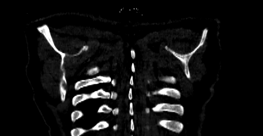 Accesory rib joint (Radiopaedia 71987-82452 Coronal bone window 86).jpg