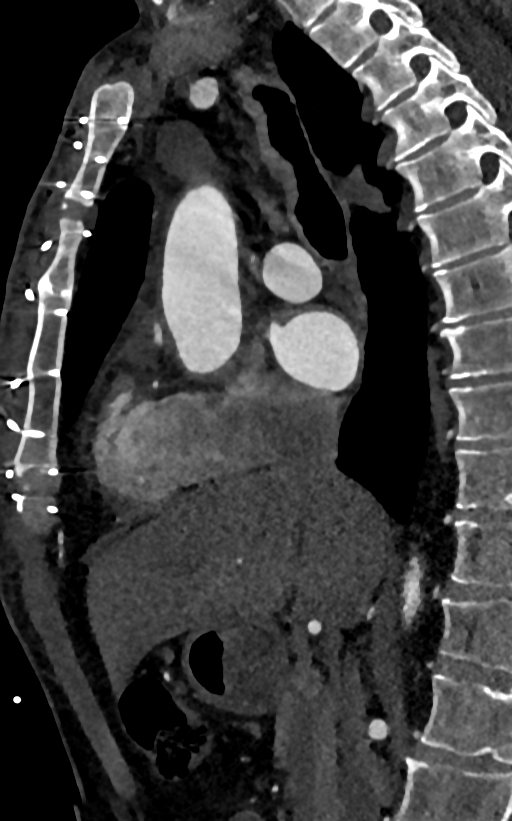 Accessory left atrial appendage (Radiopaedia 81987-95968 Sagittal C+ arterial phase 32).jpg