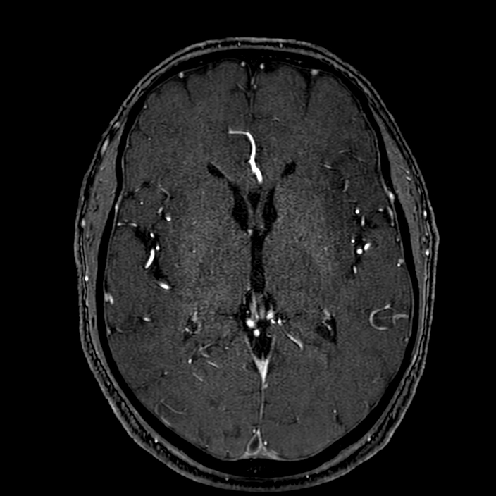 Accessory middle cerebral artery (Radiopaedia 73114-83828 Axial MRA 104).jpg