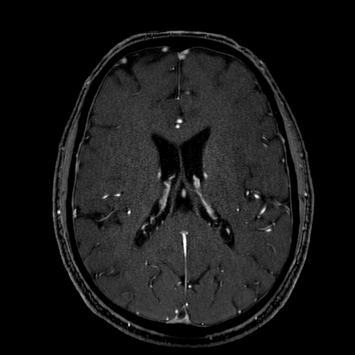 Accessory middle cerebral artery (Radiopaedia 73114-83828 Axial MRA 126).jpg